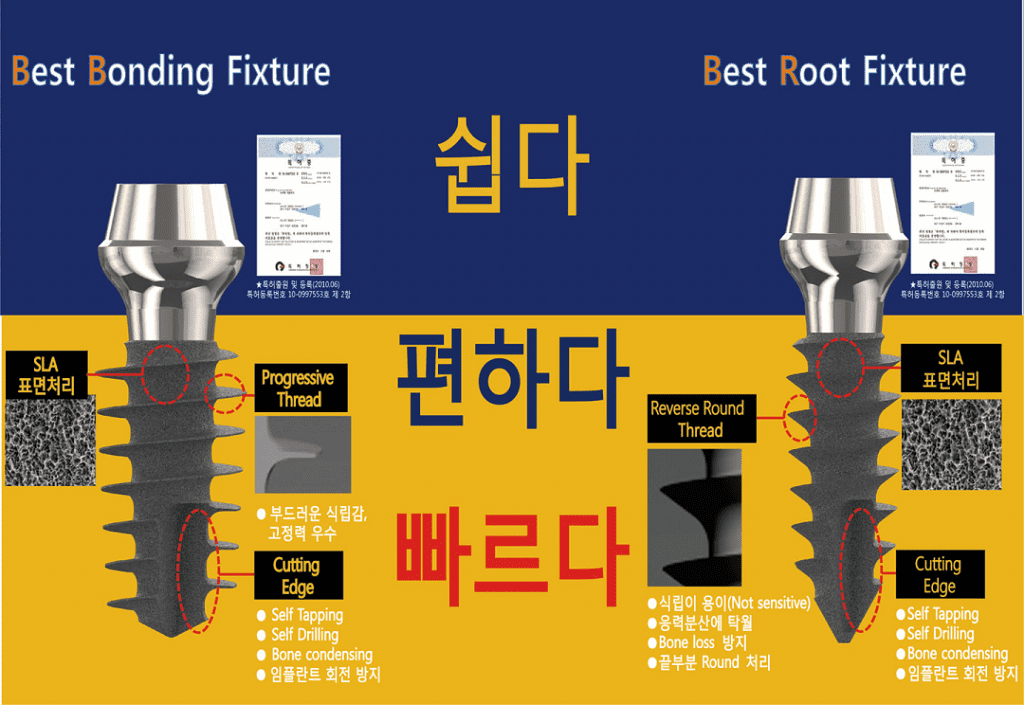 cấy ghép implant tức thì